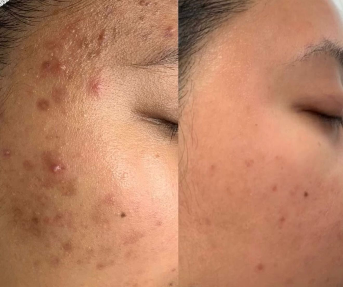 CLEARSTEN™ – Fórmula Hormonal Interna